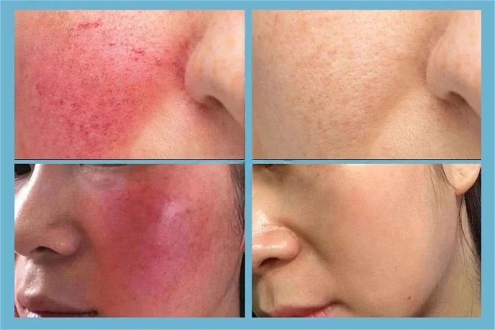 Repair Facial Redness Serum Instant