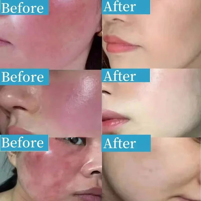 Repair Facial Redness Serum Instant